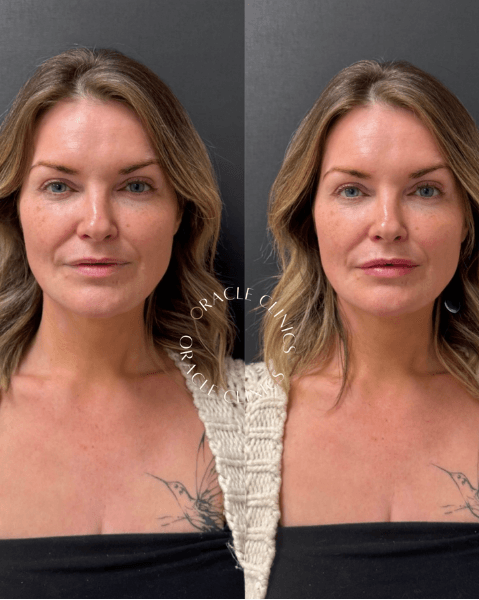 Lip fillers before and after, Morpeth: 0.5ml RHA Kiss adding subtle volume without projection, Oracle Clinics Northumberland