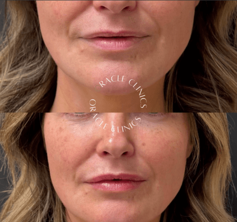 Natural lip filler before and after, Northumberland: 0.5ml RHA Kiss for a soft, natural finish, Oracle Clinics Morpeth