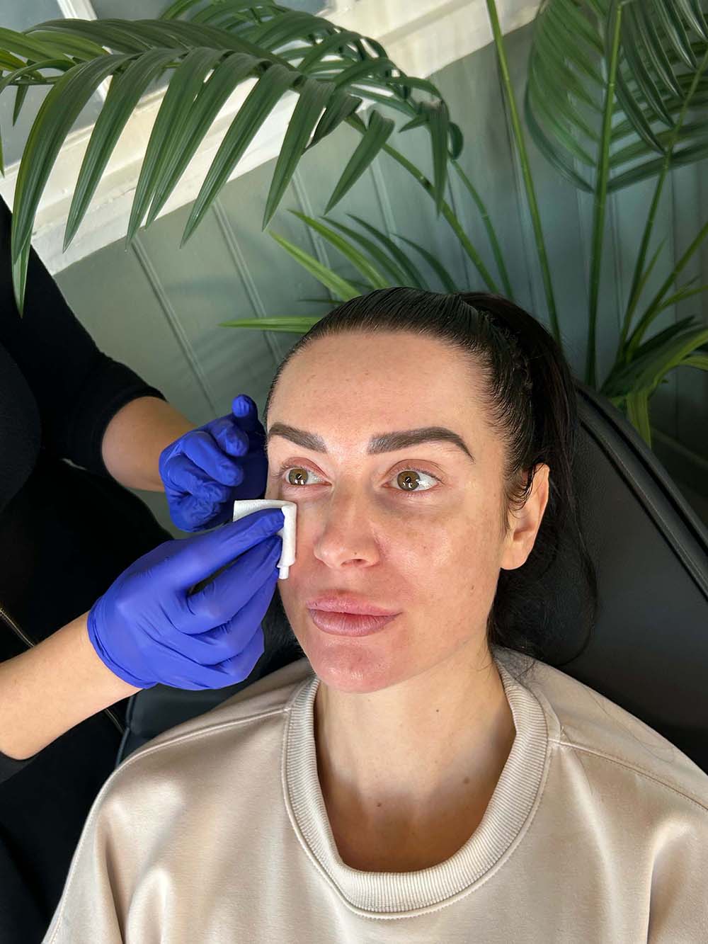 Baby botox treatment