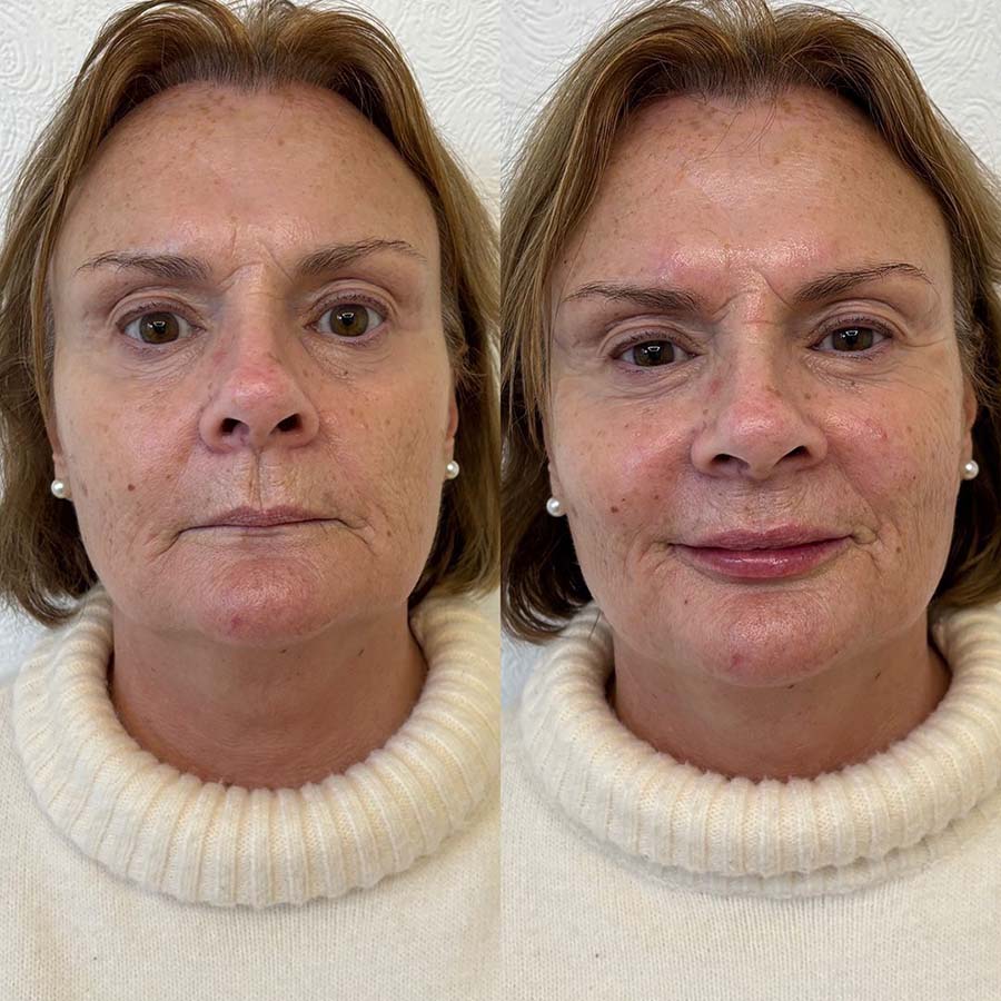 Cheek filler before and after, Oracle Clinics Northumberland