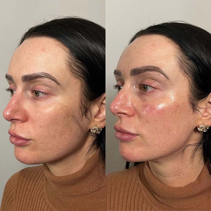 Cheek filler side profile before and after, Oracle Clinics Northumberland