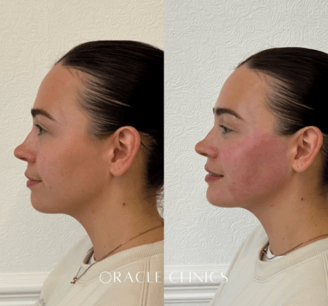 Full lower-face dermal filler before and after, Morpeth: cheek, jawline and chin enhancement for balanced facial contours, Oracle Clinics Northumberland