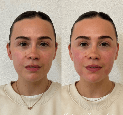 Before and after cheek, jawline and chin filler, Morpeth Northumberland: sculpted, natural-looking facial contouring, nurse-led at Oracle Clinics