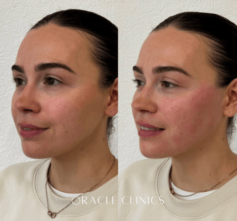Cheek, jawline and chin filler before and after, Morpeth Northumberland: restored cheek volume with jawline and chin definition, nurse-led at Oracle Clinics