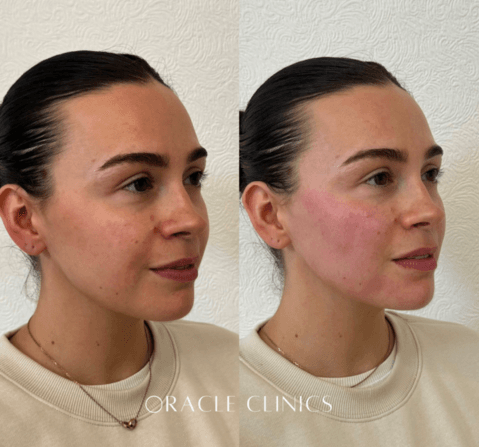 Cheek, jawline and chin filler result before and after, Morpeth: improved profile and definition, Oracle Clinics Northumberland