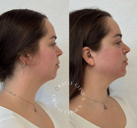 Before and after chin and jawline filler, Morpeth Northumberland: restored lower-face definition, nurse-led at Oracle Clinics