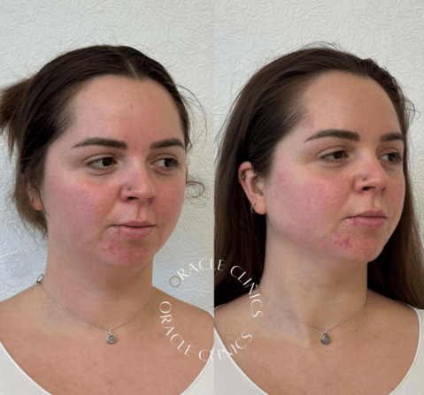 Chin and jawline dermal filler results before and after, Morpeth: sharper jawline contour and improved chin balance, Oracle Clinics Northumberland