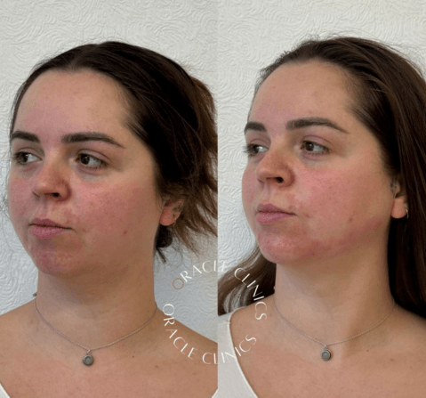 Chin and jawline filler before and after, Morpeth Northumberland: enhanced jawline definition and chin projection, nurse-led at Oracle Clinics