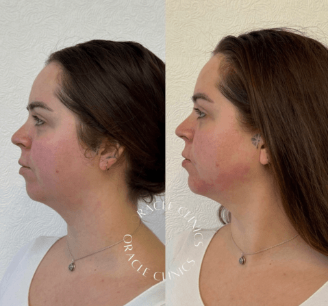 Natural chin and jawline filler result before and after, Morpeth: defined jawline and balanced chin, Oracle Clinics Northumberland