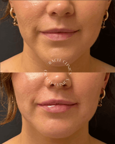 Lip filler before and after photo, Northumberland: added volume and lip definition, nurse-led at Oracle Clinics Morpeth