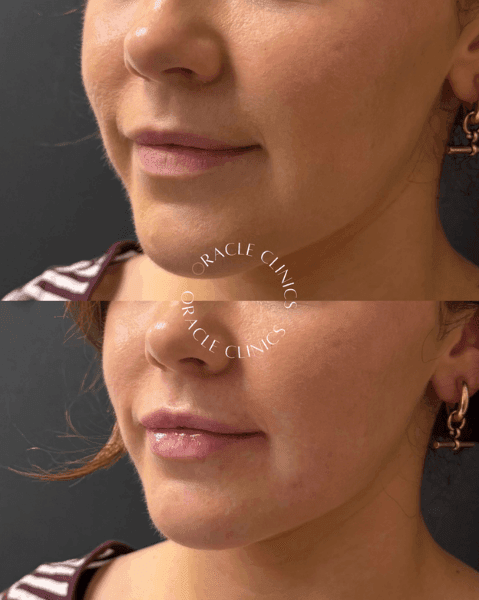 Natural lip filler results before and after, Morpeth clinic: 0.6ml RHA Kiss, Oracle Clinics Northumberland