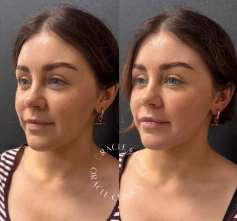 Lip fillers before and after, Morpeth Northumberland: 0.6ml RHA Kiss for softly fuller lips with enhanced definition, Oracle Clinics