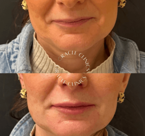 Lip filler results before and after, Morpeth: subtle, natural lip restoration by Aimee, Oracle Clinics Northumberland