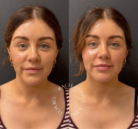 Before and after lip filler result, Morpeth: natural lip enhancement with 0.6ml RHA Kiss, Oracle Clinics Northumberland