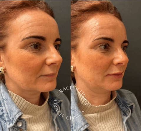 Natural lip filler before and after, Morpeth Northumberland: restored lip volume and confidence, treatment by Aimee at Oracle Clinics