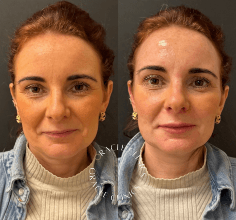 Lip fillers before and after by Aimee, Morpeth: restored lip height and rehydration for a natural result, Oracle Clinics Northumberland