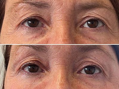 polynucleotide treatment before and after carlisle