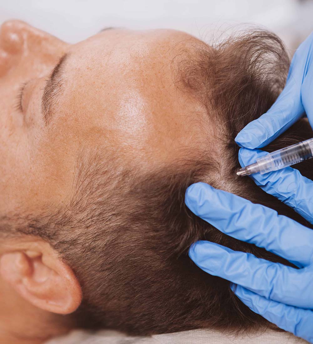 PRP hair treatment in Northumberland