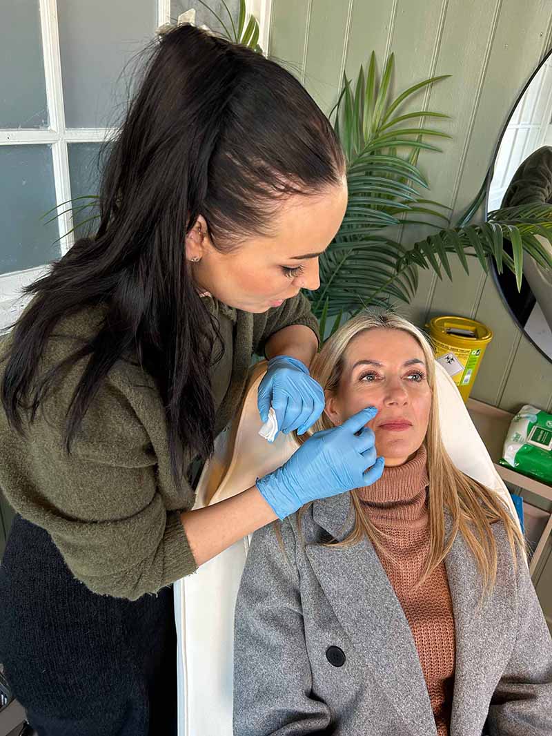 Non-surgical rhinoplasty treatment