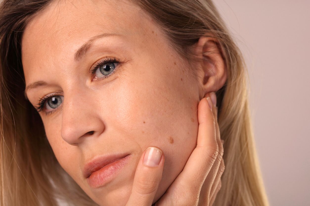 Cheek filler treatment